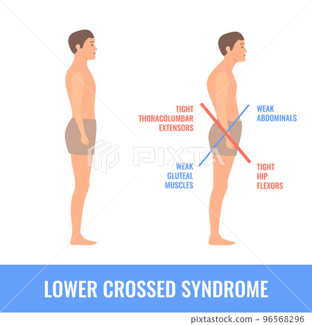 Crooked man with lower crossed syndrome imbalance Crooked man with lower crossed syndrome imbalance 96568296