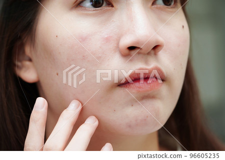 Acne pimple and scar on skin face, disorders of sebaceous glands, teenage girl skincare beauty problem. 96605235