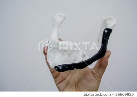 Person holding in hand 3D printed plastic prototype human lower jaw and medical titanium implant close-up. Prosthesis anatomical bone 3D printed from metal powder. Orthopedic maxillo-facial prosthesis Person holding in hand 3D printed plastic prototype human lower jaw and medical titanium implant close-up. Prosthesis anatomical bone 3D printed from metal powder. Orthopedic maxillo-facial prosthesis 96609920