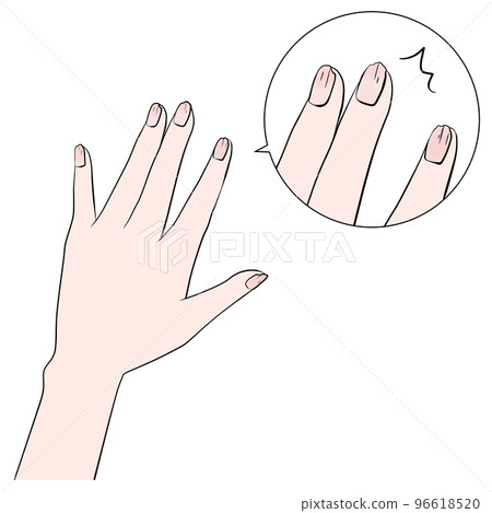 Illustration of a damaged nail (enlarged) anime painting 96618520