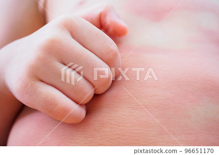 little asian baby girl hand scratch on her body with skin rash itchy and allergy 96651170