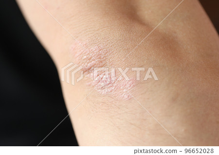 Psoriatic plaques on elbow of patient with skin disease closeup 96652028