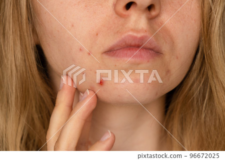 Unrecognizable woman showing her acne on face. Close-up acne on woman's face with rash skin ,scar and spot that allergic to cosmetics. Problem skincare and health concept. Wrinkles, melasma, dark 96672025