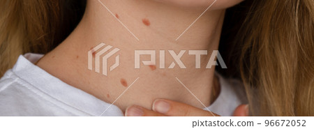 Unrecognizable woman showing her Birthmarks on neck skin Close up detail of the bare skin Banner Sun Exposure effect on skin, Health Effects of UV Radiation Woman with birthmarks Pigmentation Unrecognizable woman showing her Birthmarks on neck skin Close up detail of the bare skin Banner Sun Exposure effect on skin, Health Effects of UV Radiation Woman with birthmarks Pigmentation 96672052