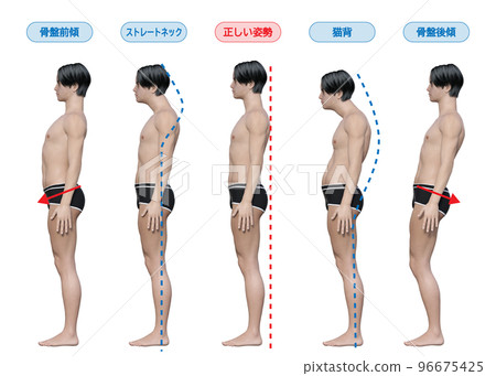 好姿勢 壞姿勢 直頸 駝背 骨盆傾斜 骨盆後傾斜 男人全身側向 3D 插畫 96675425
