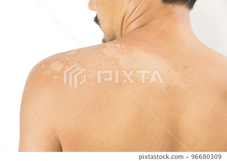 Sunburn. Asian man with massive sunburn on his body isolated on white background. Sunburn. Asian man with massive sunburn on his body isolated on white background. 96680309