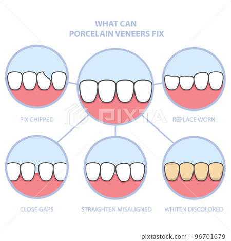 Teeth and smile makeover with dental ceramic veneers, row of teeth fixed with veneer cover, before and after teeth, vector 96701679