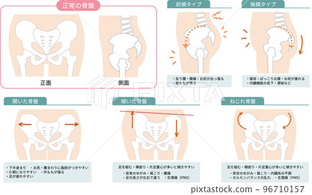 顯示正常和扭曲的骨盆位置和症狀的說明性插圖 96710157