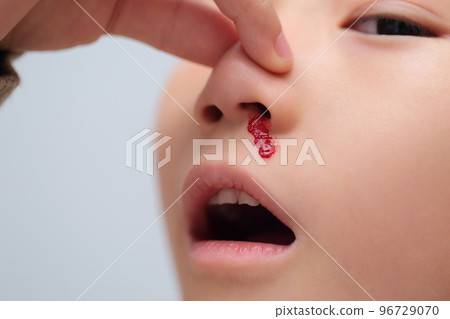Elementary school girl with nosebleed (image with blood) 96729070
