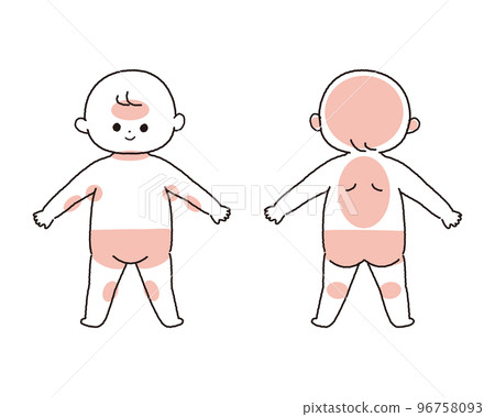 插圖顯示嬰兒汗疹可能出現的區域 96758093