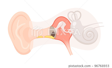 Illustration of ear structure_chronic otitis media_tympanic membrane perforation and ear discharge Illustration of ear structure_chronic otitis media_tympanic membrane perforation and ear discharge 96768933