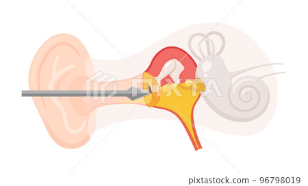 Illustration of tympanostomy for otitis media with effusion 96798019