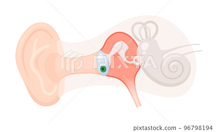 插入耳膜管的插圖_中耳炎 96798194
