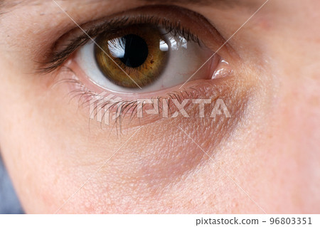 A macro photo of the human eye is a bruise under the eye, a tired look A macro photo of the human eye is a bruise under the eye, a tired look 96803351