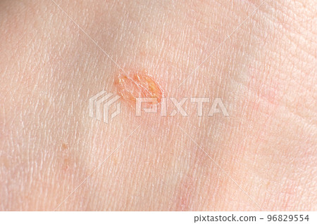 Streptoderma - dermatitis on human skin, red round spot, macro photography, bacterial inflammation Streptoderma - dermatitis on human skin, red round spot, macro photography, bacterial inflammation 96829554
