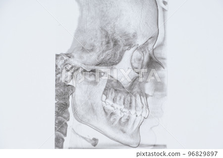 CT scan of a patient with malocclusion, missing chewing tooth and temporomandibular joint dysfunction. CT scan of a patient with malocclusion, missing chewing tooth and temporomandibular joint dysfunction. 96829897