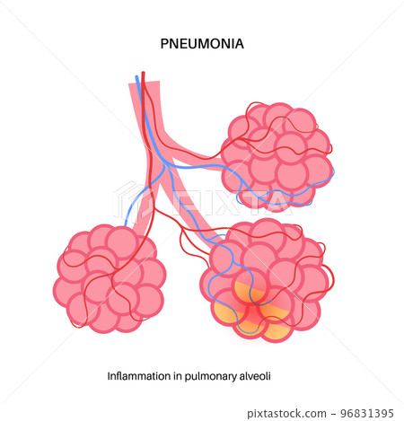 Pneumonia infection concept Pneumonia infection concept 96831395