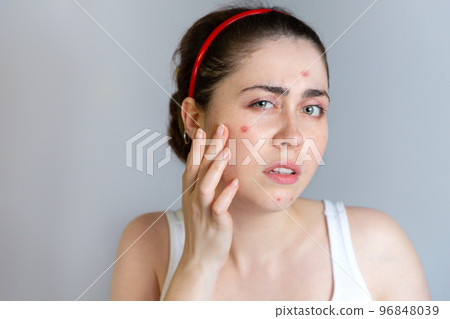 Young cute brunette woman examines her face with pimples. The concept of cosmetology and acne control, adolescence. Copy space 96848039