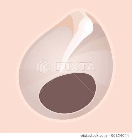 鼓膜穿孔圖解 96854044