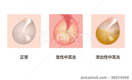 Illustration of eardrum of otitis media _ normal _ acute otitis media _ otitis media with effusion Illustration of eardrum of otitis media _ normal _ acute otitis media _ otitis media with effusion 96854098