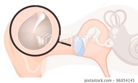 耳朵結構與耳膜示意圖_正常耳膜 耳朵結構與耳膜示意圖_正常耳膜 96854145