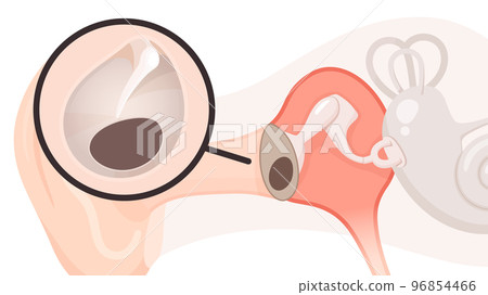 耳朵和鼓膜結構示意圖_慢性中耳炎_鼓膜穿孔 耳朵和鼓膜結構示意圖_慢性中耳炎_鼓膜穿孔 96854466
