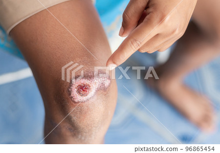 wound healing scar on kid knee from accident in daily life. health relation image for healthy content. 96865454