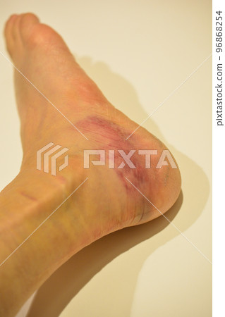 扭傷腳踝紅腫 96868254