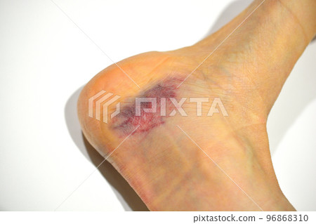 扭傷腳踝紅腫 96868310