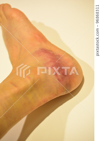 扭傷腳踝紅腫 96868311