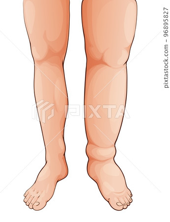 Edema swollen leg and foot. Lymphedema. Oedema disease symptom, fluid retention in legs, lymph circulatory problem and body tissue inflammation or thrombosis syndrome medical vector illustration 96895827