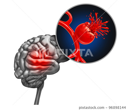 Ruptured Brain Aneurysm Ruptured Brain Aneurysm 96898144