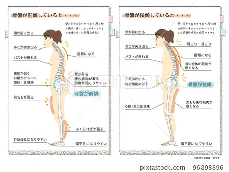 A sideways illustration showing the symptoms and conditions that occur when a person's pelvis tilts backwards and forwards A sideways illustration showing the symptoms and conditions that occur when a person's pelvis tilts backwards and forwards 96898896