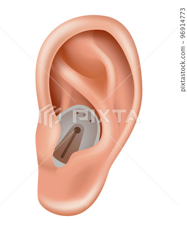 Hearing aid. Sound amplifier for patients with hearing loss. Medicine and health. Realistic object behind the ear. Treatment and prosthetics in otolaryngology 96914773