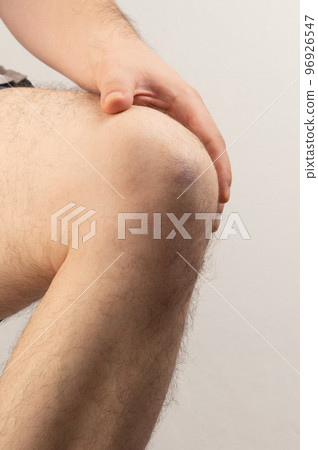 Damaged knee close up view Damaged knee close up view 96926547