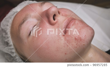 A girl with problem skin of the face at the reception of a beautician. 96957285