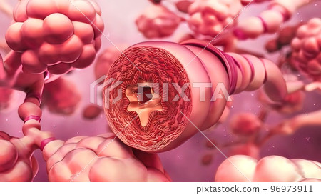 obstruction of the bronchi 3d obstruction of the bronchi 3d 96973911