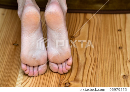 Closeup of woman feet sole with dry cracked skin. Foot and toes care concept. Closeup of woman feet sole with dry cracked skin. Foot and toes care concept. 96979353