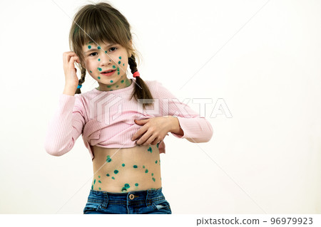 Child girl covered with green rashes on face and stomach ill with chickenpox, measles or rubella virus. Child girl covered with green rashes on face and stomach ill with chickenpox, measles or rubella virus. 96979923