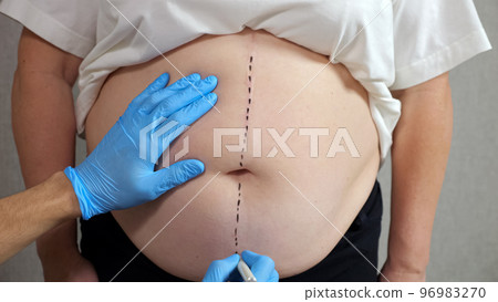 Hand of specialist makes marks on belly of curvy woman Hand of specialist makes marks on belly of curvy woman 96983270