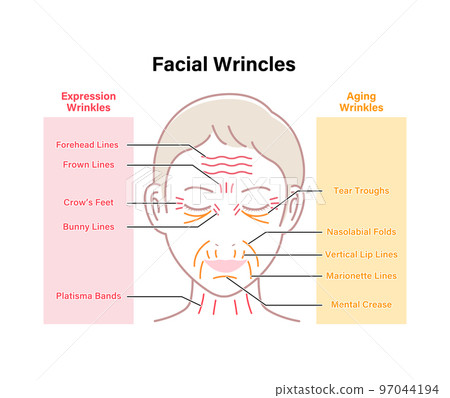 Wrinkles on a woman's face (facial expression wrinkles and sagging wrinkles) Vector illustration / English 97044194