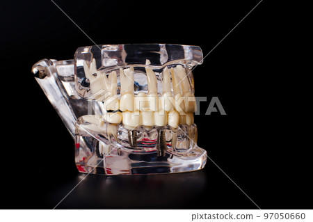 Dentist dental prosthetic teeth, gums, roots close-up. Studying dental diseases concept 97050660