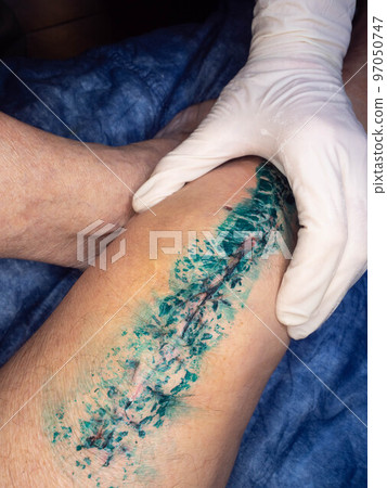 Wound after knee prosthesis operation exchange. Removing of knee joint Wound after knee prosthesis operation exchange. Removing of knee joint 97050747