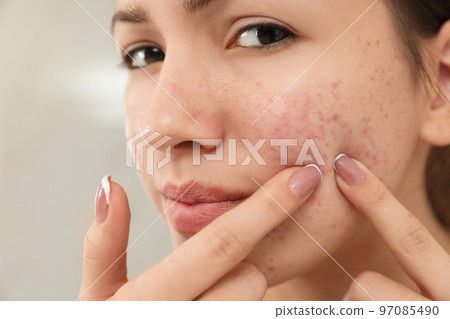 Teen girl with acne problem squeezing pimple on her face, closeup Teen girl with acne problem squeezing pimple on her face, closeup 97085490