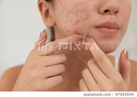 Teen girl with acne problem squeezing pimple on her face, closeup Teen girl with acne problem squeezing pimple on her face, closeup 97085694