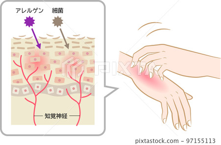 特應性皮炎皮膚細胞抓手 特應性皮炎皮膚細胞抓手 97155113