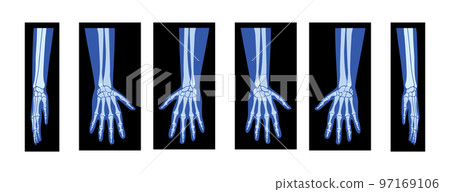 Set of X-Ray Hands with Radius, Ulna Skeleton Human body, Bones adult people roentgen front back side view. 3D realistic Set of X-Ray Hands with Radius, Ulna Skeleton Human body, Bones adult people roentgen front back side view. 3D realistic 97169106