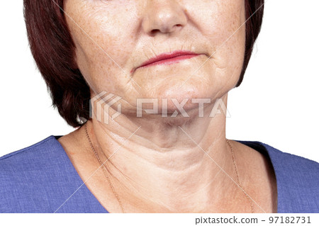 The lower part of the face and neck of an elderly woman with signs of skin aging isolated on a white background. Age-related changes, flabby sagging skin of the face. Cosmetology and beauty concept The lower part of the face and neck of an elderly woman with signs of skin aging isolated on a white background. Age-related changes, flabby sagging skin of the face. Cosmetology and beauty concept 97182731