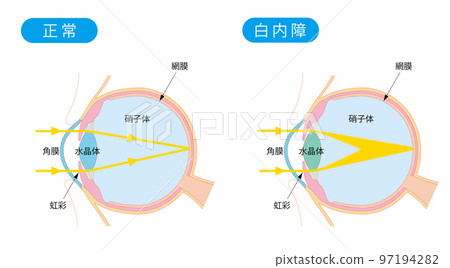 Cross section of a normal eye and a cataract eye Cross section of a normal eye and a cataract eye 97194282