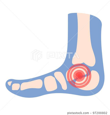 Foot articulation icon cartoon vector. Medical patient. Arthritis joint Foot articulation icon cartoon vector. Medical patient. Arthritis joint 97200802